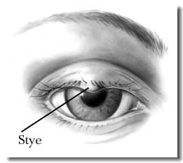 How To Get Rid Of A Stye Fast